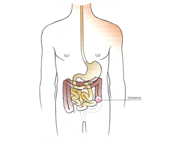STOMA CARE GUIDE