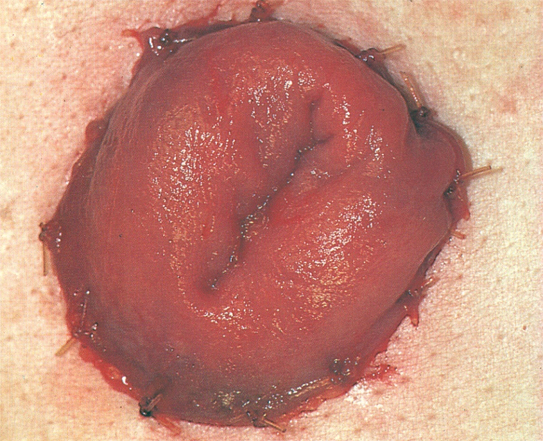 STOMA CARE GUIDE